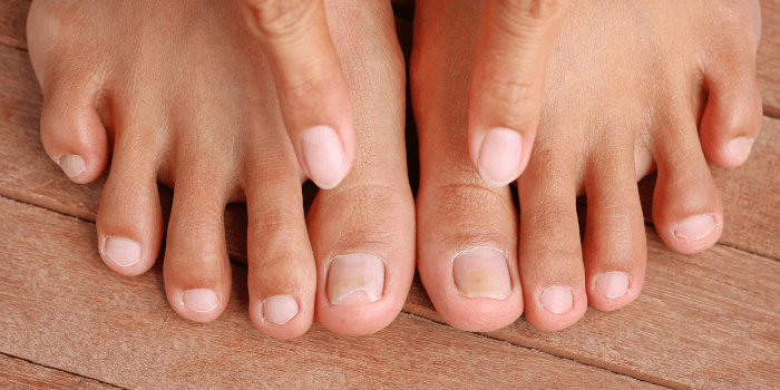 Teebaumöl bei Nagelpilz