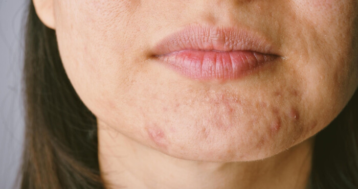 Unreine Gesichtshaut Pickel Hormone Anti Pickel Patches Pimple Patches